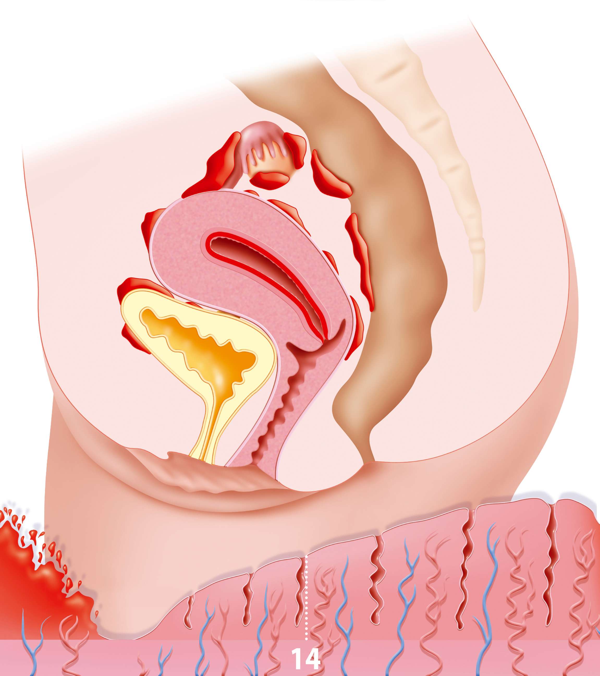 PHOTO: Endometriosis is the presence of the uterine lining outside the uterine cavity.