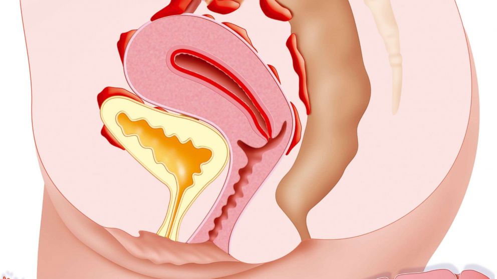 PHOTO: Endometriosis is the presence of the uterine lining outside the uterine cavity.