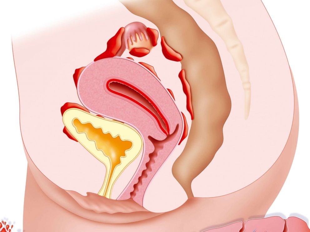 PHOTO: Endometriosis is the presence of the uterine lining outside the uterine cavity.