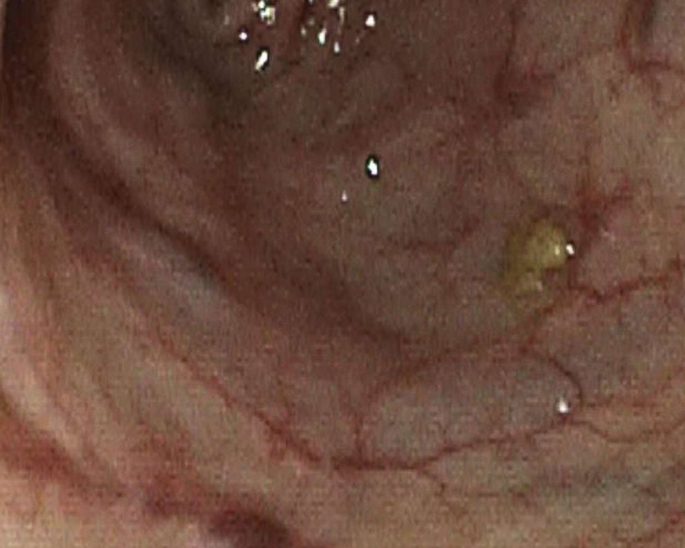 PHOTO: An undated image taken from an upper endoscopy shows esophageal cancer.
