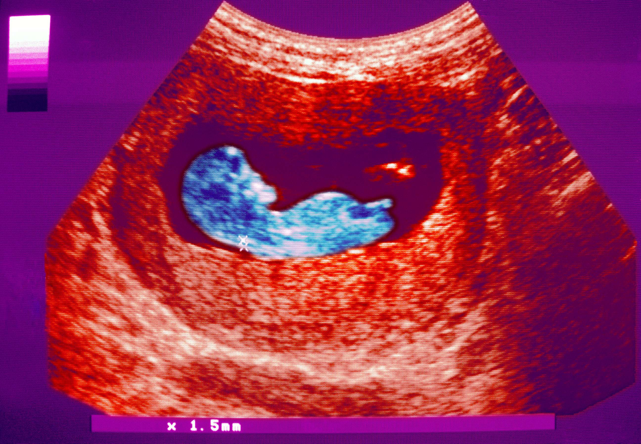 PHOTO: A colorized sonogram shows a human fetus at 12 weeks development.
