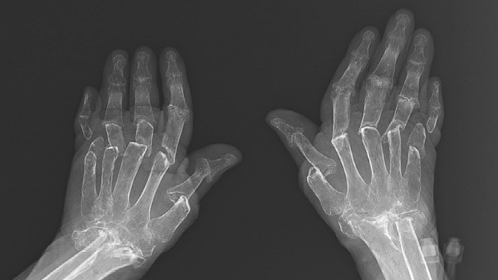 PHOTO: A 69-year-old woman in Turkey developed a rare condition known as "telescoping fingers."