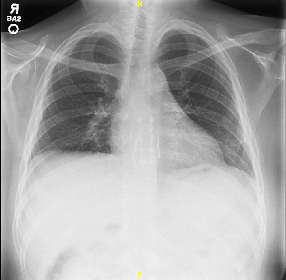 PHOTO: Joshua Garza's lung x-ray after a double lung transplant, which is a normal looking X-ray with the dark areas representing normal air distribution.