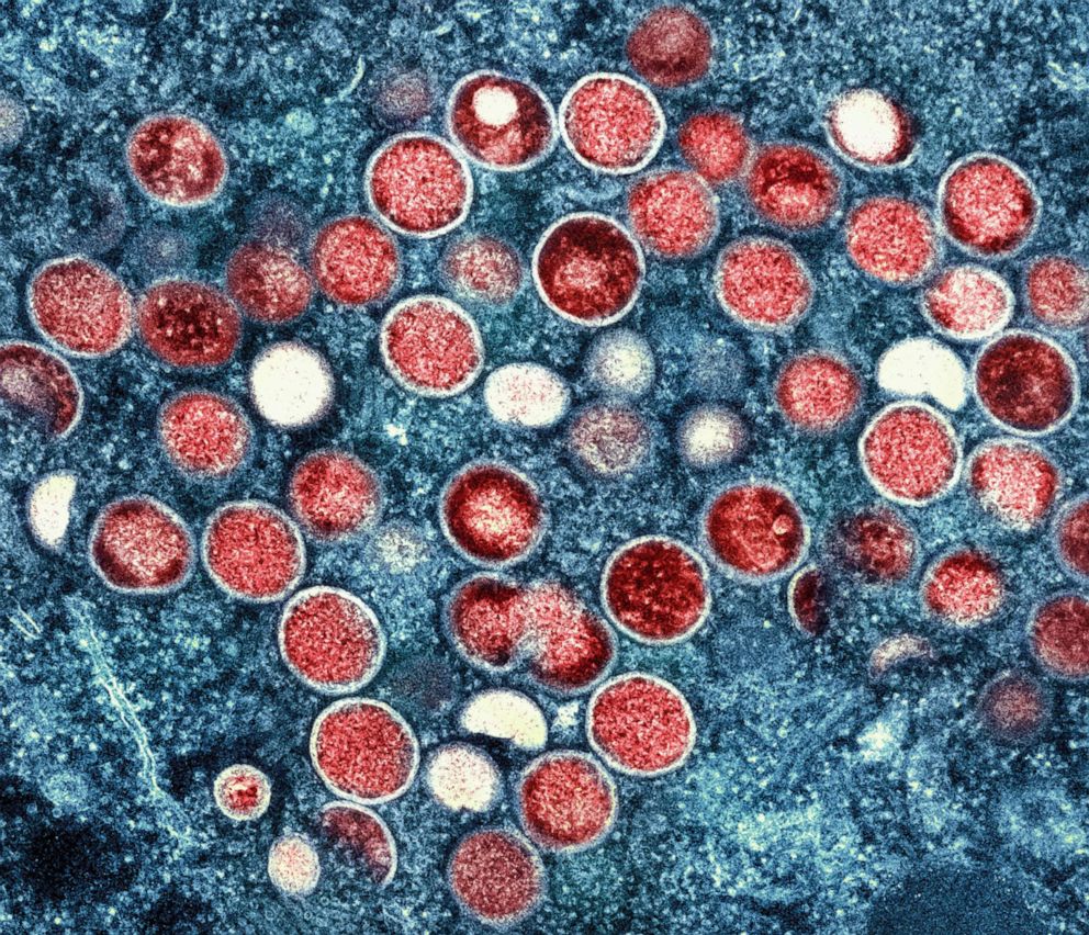 PHOTO : Une micrographie électronique à transmission colorisée montre des particules de monkeypox (rouge) trouvées dans une cellule infectée (bleue) cultivée en laboratoire et capturée et rehaussée de couleur au NIAID Integrated Research Facility à Fort Detrick, Maryland.