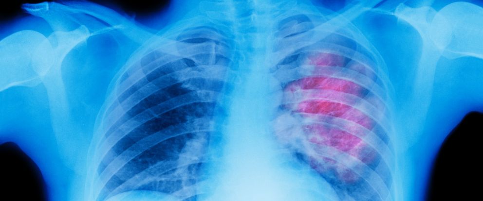 CubanDeveloped Lung Cancer Vaccine Could Arrive in US