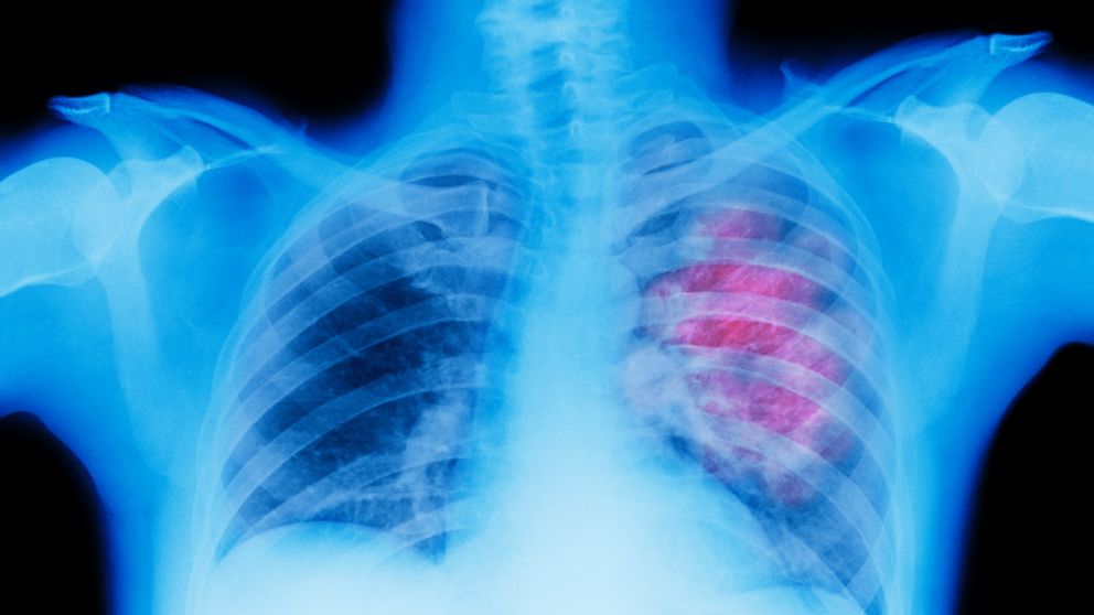 X-ray of lung showing chest cancer.