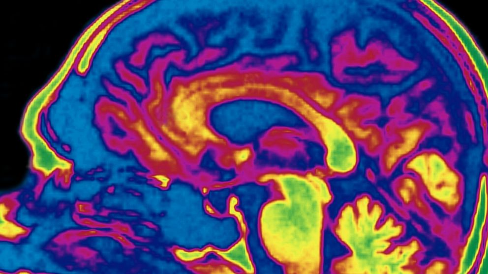 Researchers are investigating how sex affects the human brain.