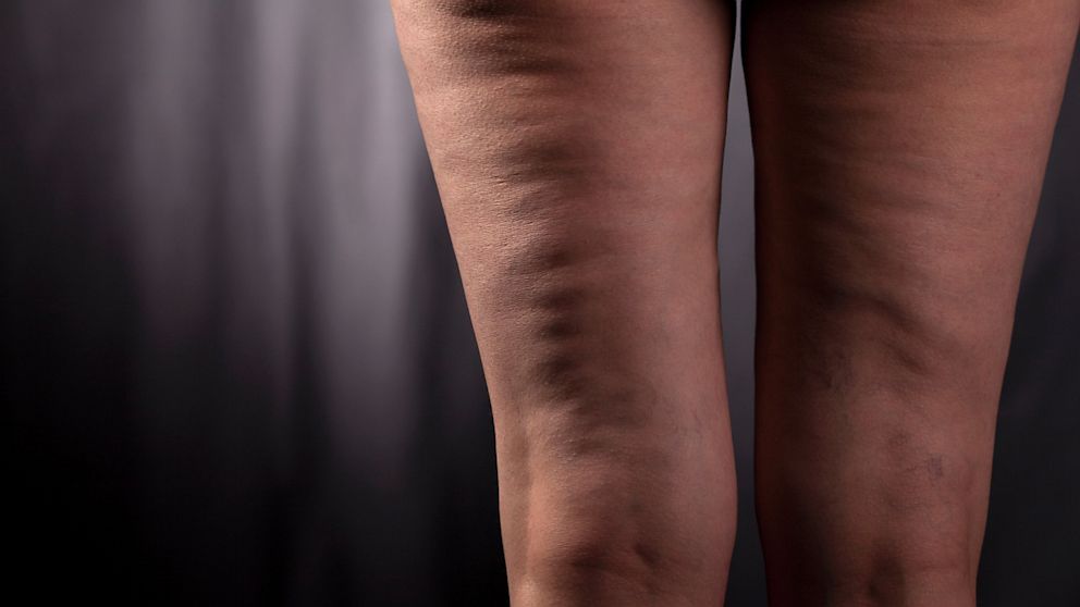 What Is Cellulite On Your Legs