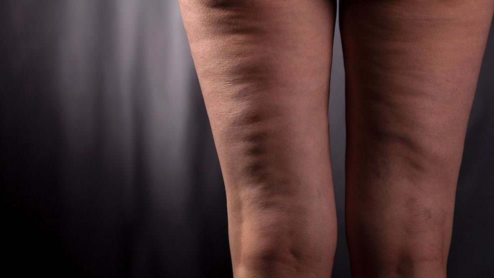 Woman with fat build up condition taunted for 'melted yoghurt' legs