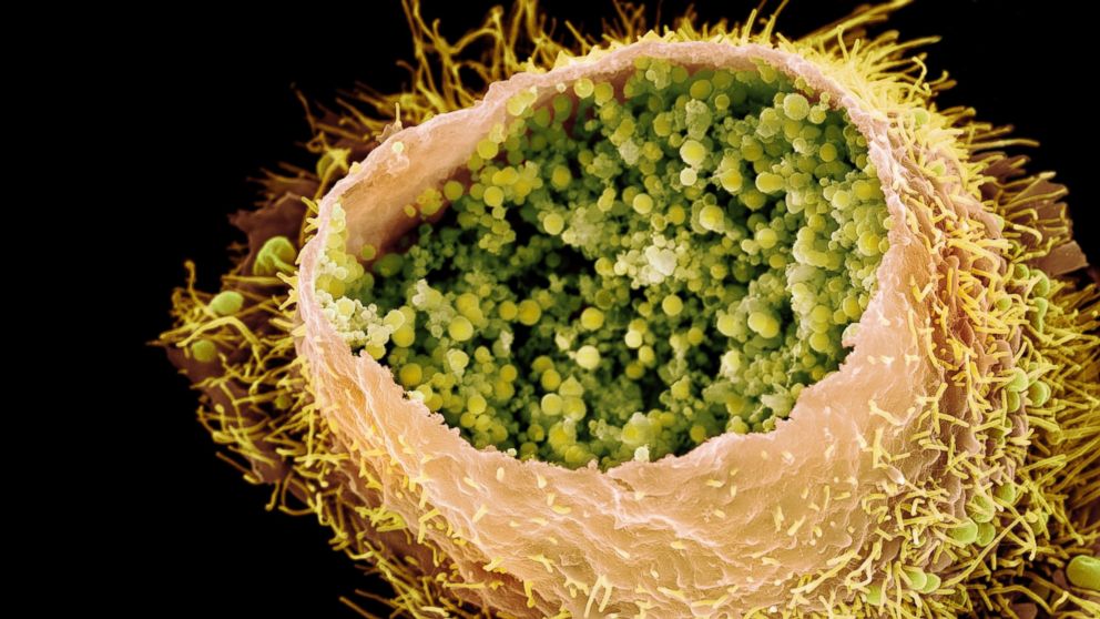 PHOTO: A colorized scanning electron micrograph shows a cultured human cell infected by Chlamydia trachomatis bacteria, appearing as small round particles inside the cell wall.
