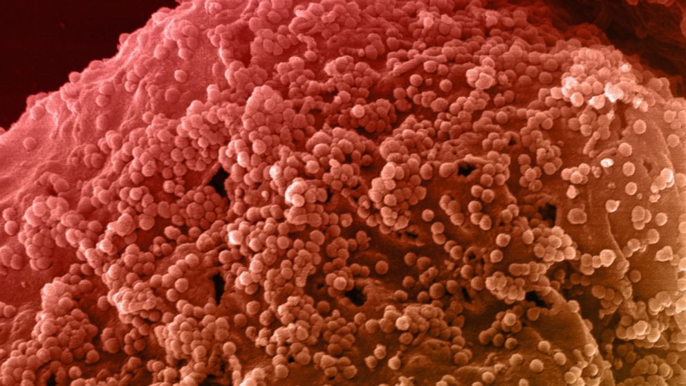 Researchers have announced a rare case where an HIV-positive teen has successfully stopped taking medication for 12 years. Pictured: A stock image from a scanning electron microscope shows an HIV infected cell. 