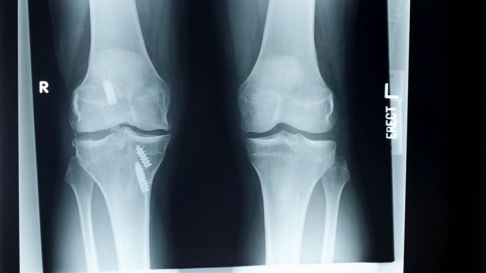Three common knee injuries explained. 