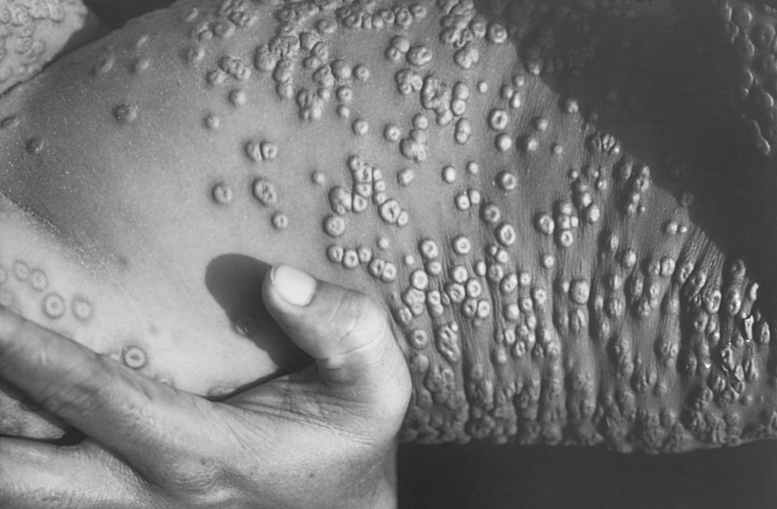 PHOTO: Smallpox legions are shown on a patient in this 1973 photograph in Bangladesh.