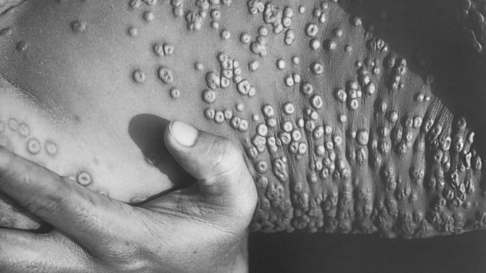 PHOTO: Smallpox legions are shown on a patient in this 1973 photograph in Bangladesh.