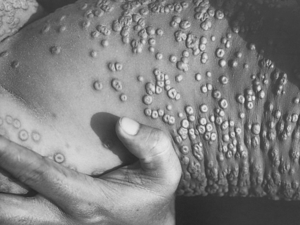 PHOTO: Smallpox legions are shown on a patient in this 1973 photograph in Bangladesh.