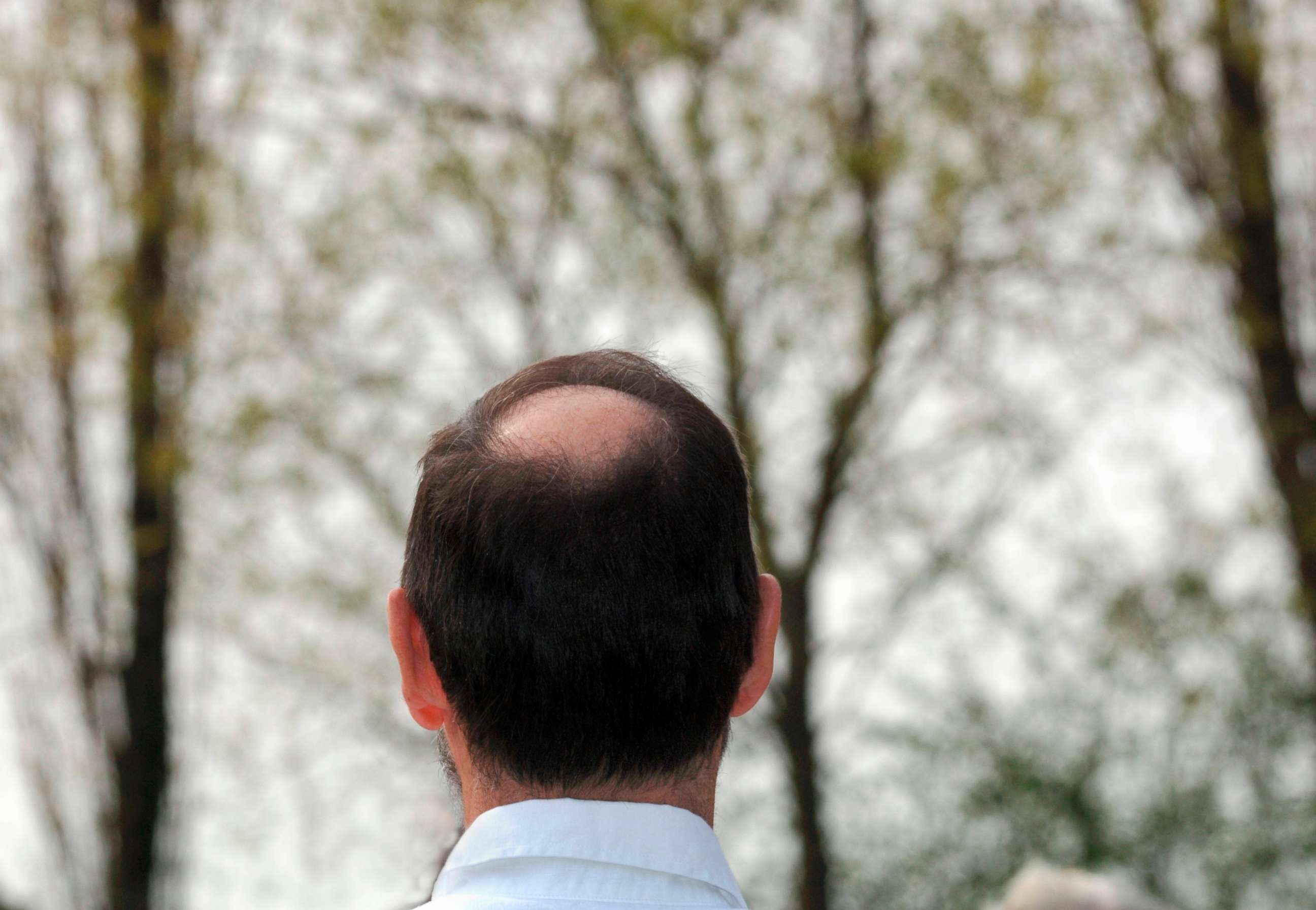 PHOTO: This stock photo depicts a balding man.