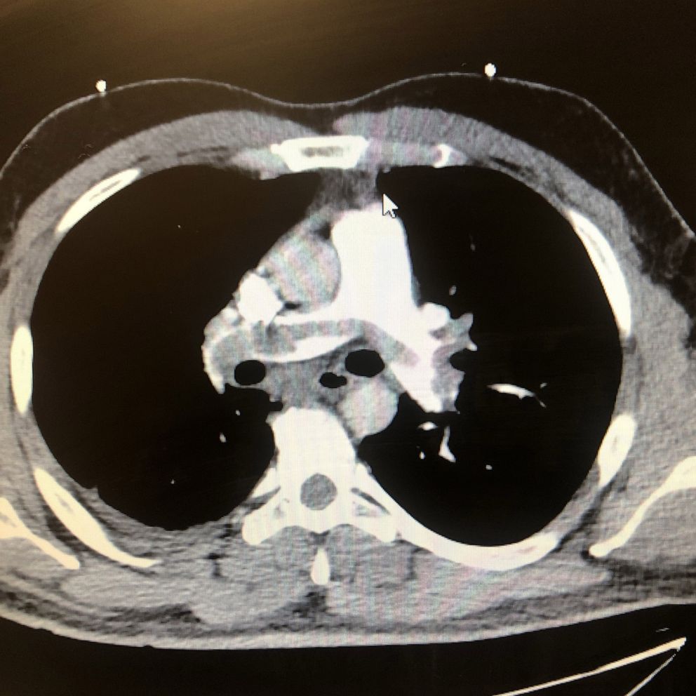 PHOTO: A CT Scan of a heart from a man in his 30s, tested positive for coronavirus, with a massive saddle embolus in the pulmonary arteries.