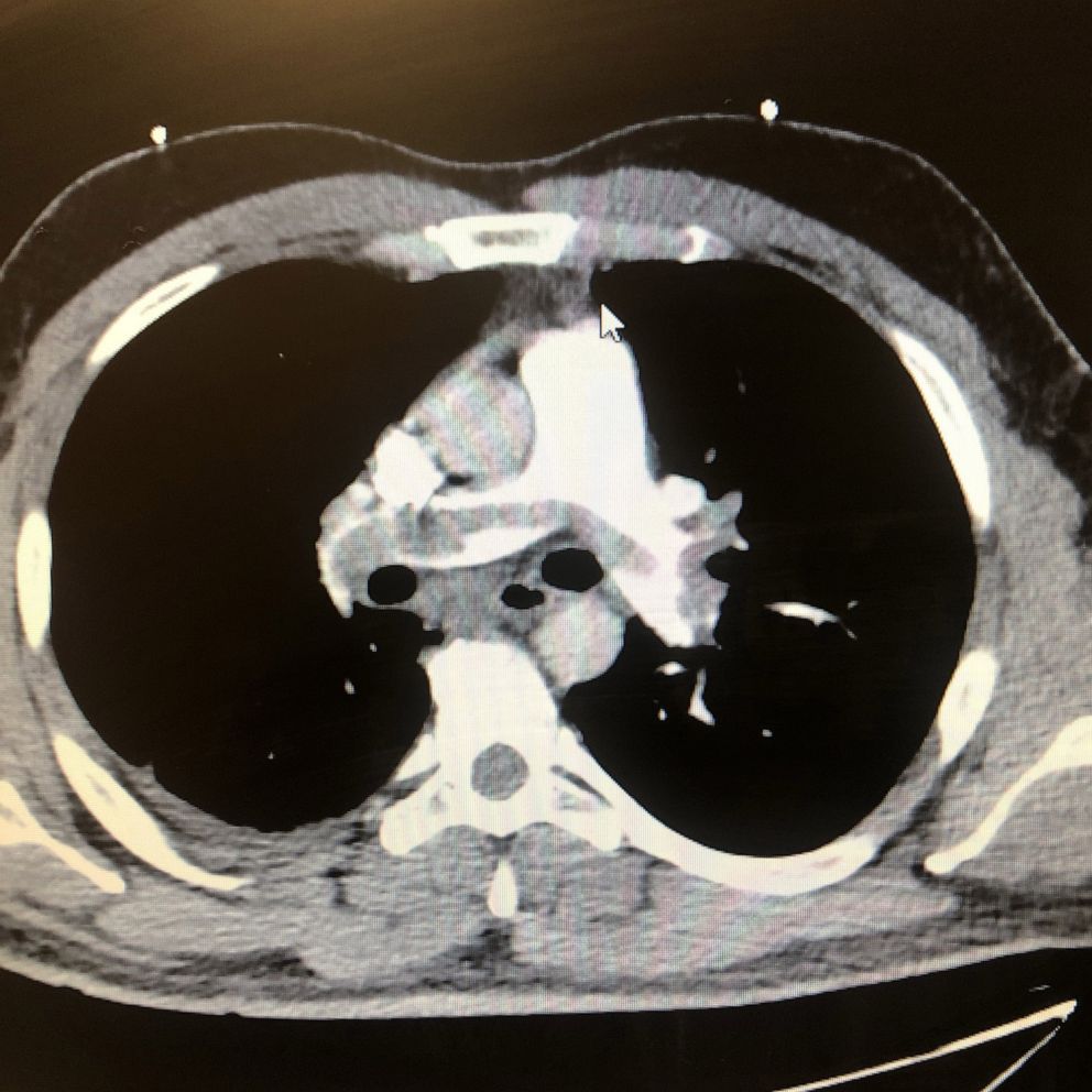 A blood clot formed in the exact shape of a man's lung passage