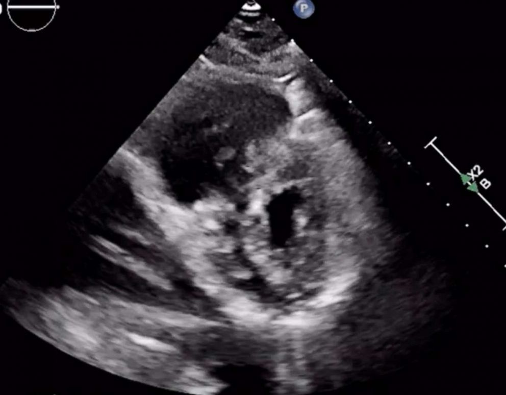 PHOTO: An echocardiogram (ultrasound) of the heart of a man in his 30s, tested positive for coronavirus, showing damage to the right side of the heart.