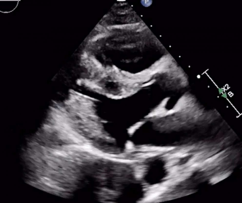 PHOTO: An echocardiogram (ultrasound) of the heart of a man in his 30s, tested positive for coronavirus, showing damage to the right side of the heart.