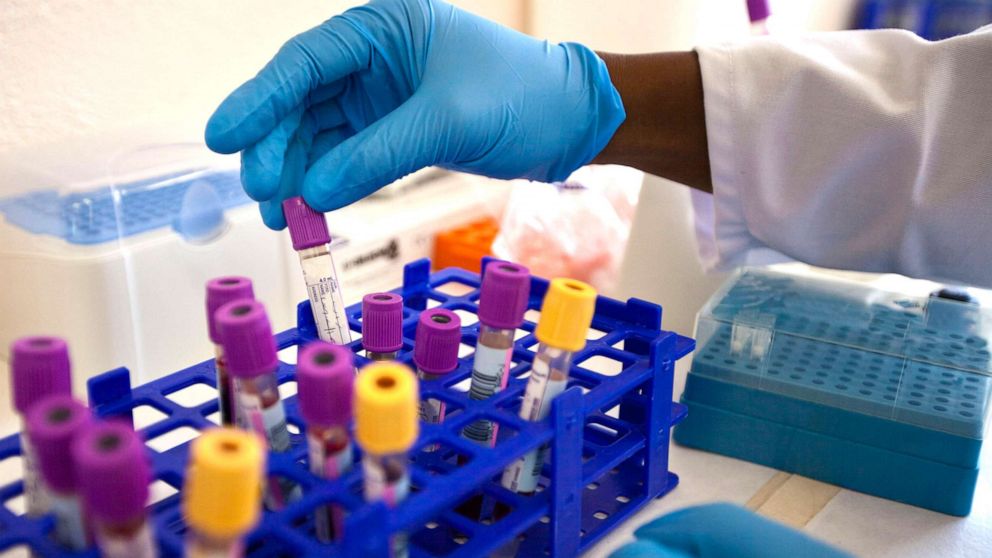 PHOTO: Blood samples for testing patients for HIV are seen at a clinic in an undated photo. 