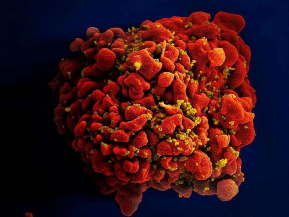 PHOTO: A human white blood cell infected with HIV virus.  