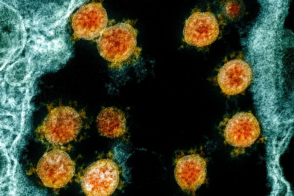 PHOTO: This electron microscope image shows Novel Coronavirus SARS-CoV-2 virus particles, orange, isolated from a patient.