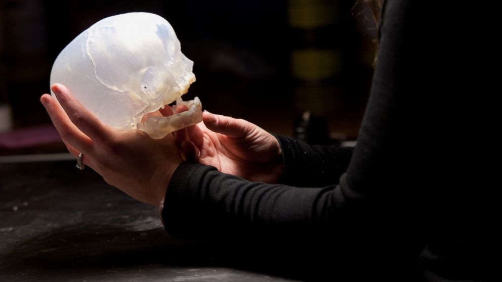 PHOTO: This replica of a patient's skull can be critical acts as a guide to help surgeons prepare for their surgeries.
