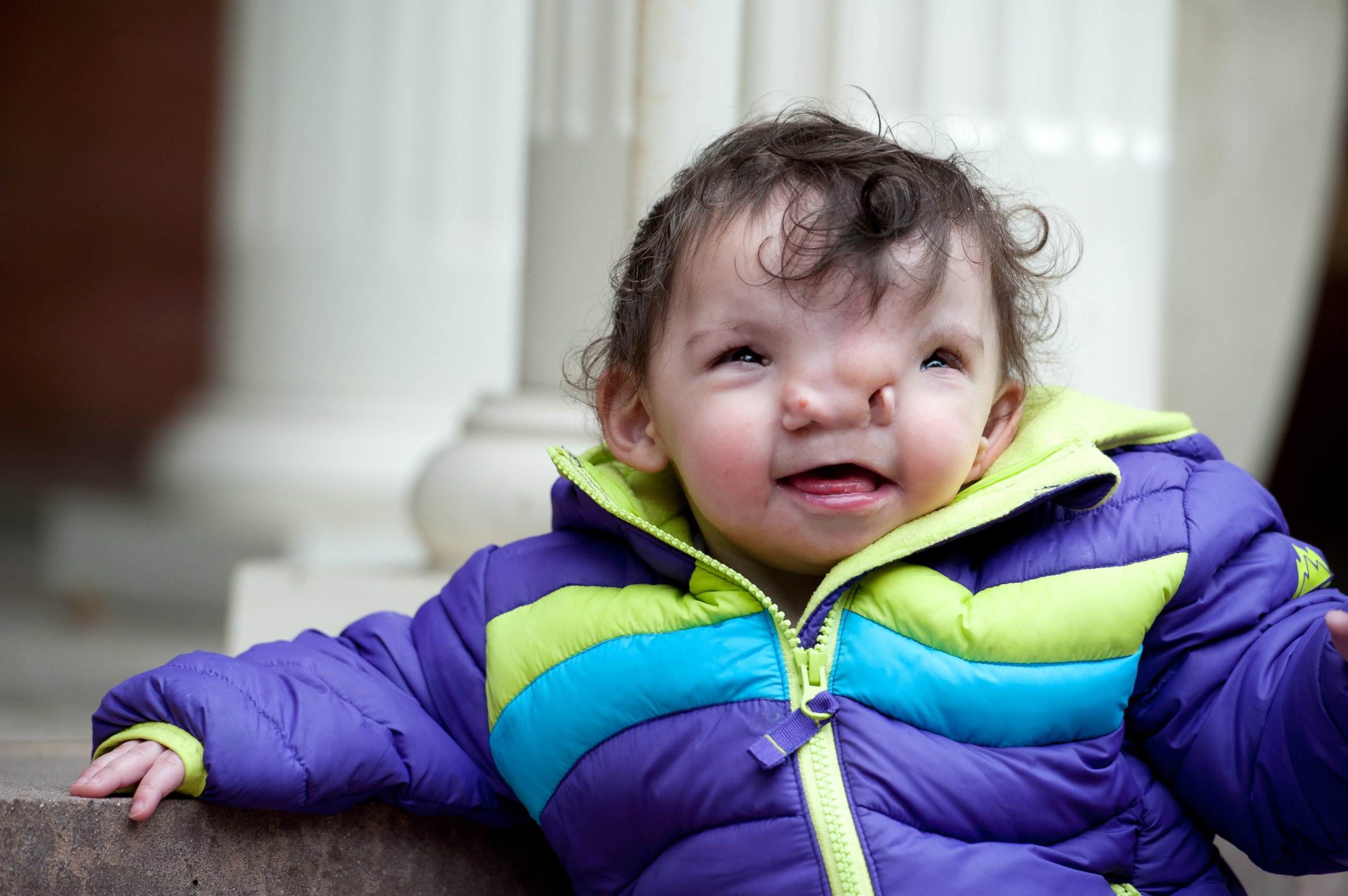 PHOTO: Violet was born with a rare condition that resulted in a widening of certain features in her face. 