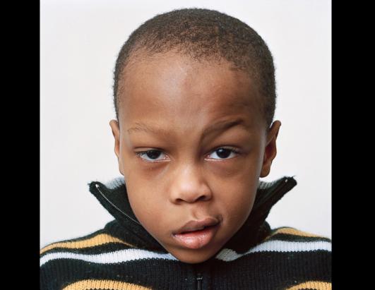 About Face: Alluring Portraits of People with Facial Paralysis Picture ...