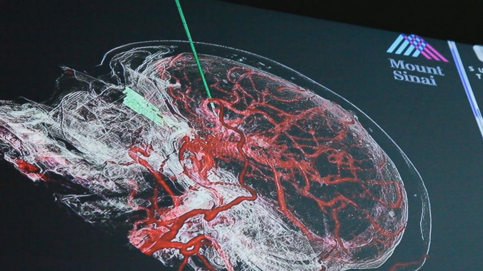 PHOTO: A surgeon uses VR and Augmented Tech to create 'Road Map' during brain surgery.