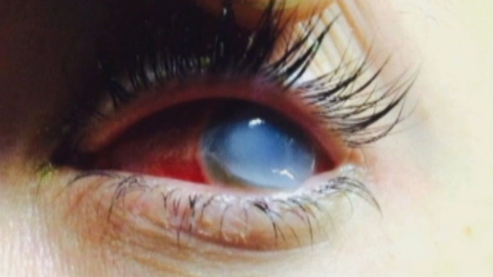 PHOTO: A suspected bacterial infection irreversibly damaged Brittany Williams’ cornea and she now thinks she will have to have a cornea transplant to see again.