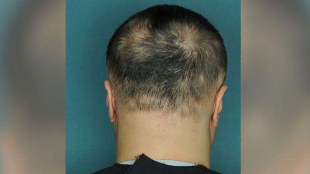 Alopecia is an autoimmune condition that causes patchy baldness. 