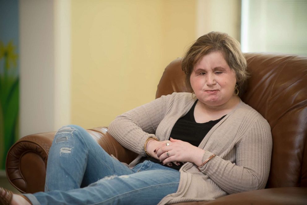 Katie Stubblefield is seen here after her face transplant surgery at the Ronald McDonald House in Cleveland, Ohio.