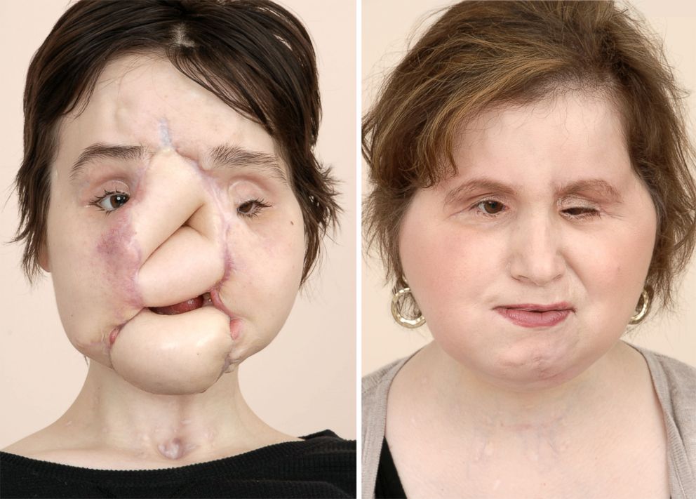 Katie Stubblefield is seen here before and after her multiple surgeries, including a face transplant procedure.