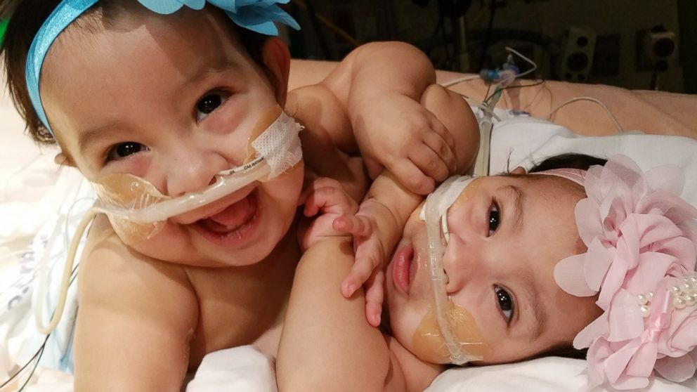 PHOTO: Ten-month-old twins Knatalye and Adeline Mata were conjoined at birth, and underwent a highly complicated separation surgery at Texas Children's Hospital in Houston, Texas.