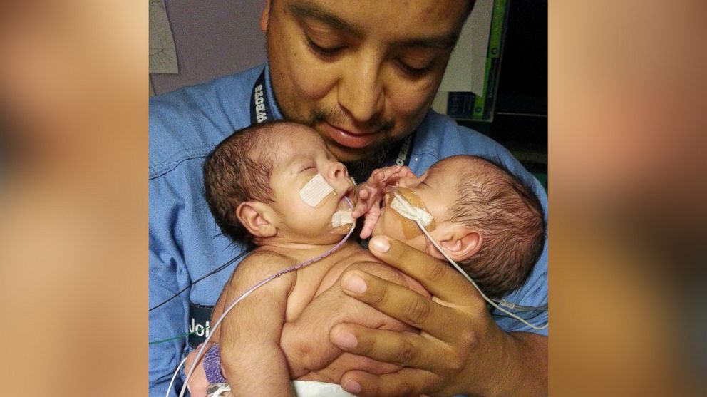 PHOTO: Conjoined twins Knatalye and Adeline Mata were born on April 11, 2014, 9 weeks premature, at Texas Children's Hospital in Houston, Texas.