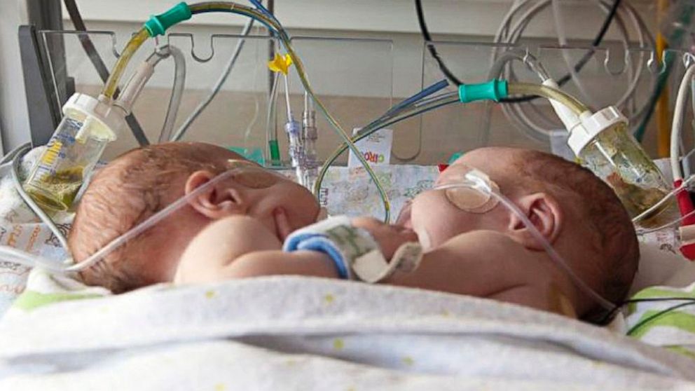 Conjoined boys Emmett, left and Owen Ezell are shown in this undated photo at Medical City Children's Hospital in Dallas.