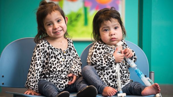 Formerly Conjoined Texas Twins Celebrate One Year Since Separation Abc News