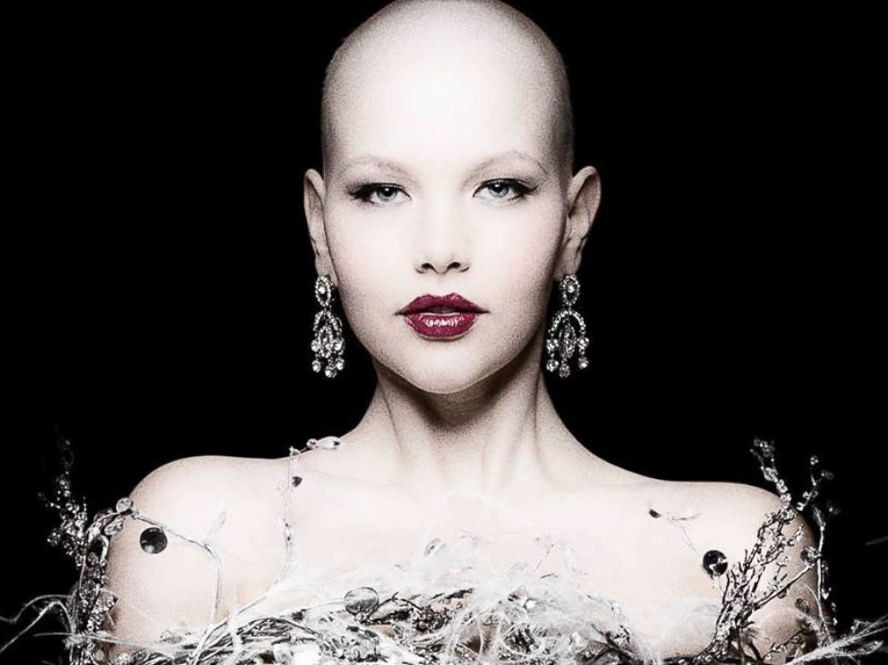 Plus Model Elly Mayday Continues To Pose Despite Bald Head Scars Abc News