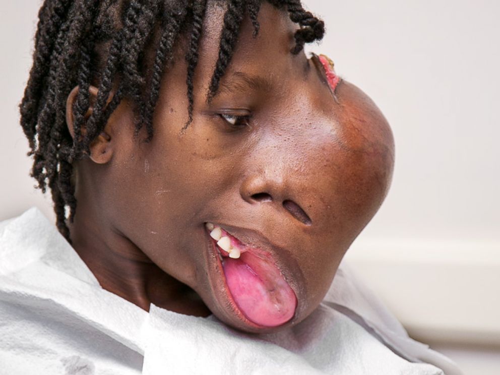 Man with huge face tumor reveals surgery results