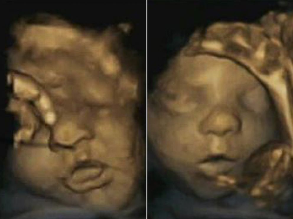 PHOTO: A 35-week fetus and a 28-week fetus show different mouth movements in a study entitled, "Development of prenatal lateralization: Evidence from fetal
2 mouth movements."