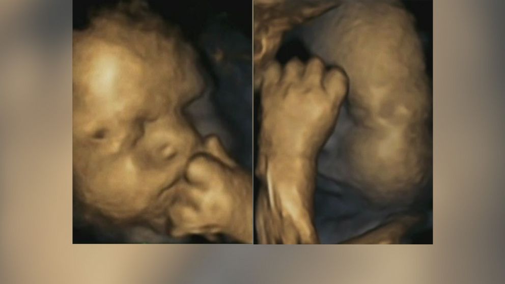 Fetuses are more likely to touch their faces with their left hands if their moms are stressed, researchers say.