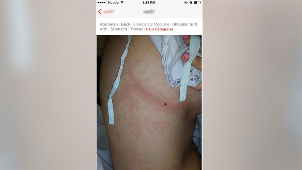 PHOTO: A person with characteristic branching markings from being struck by lightning.