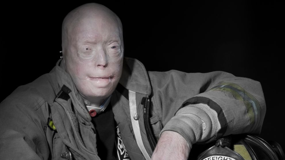 Pat Hardison is shown here in his firefighter uniform before his face transplant surgery at NYU Langone Medical Center. 