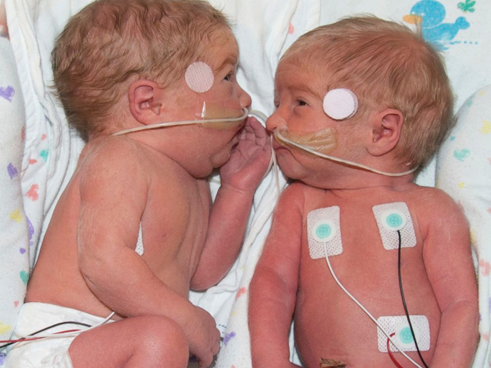 PHOTO: Peyton and Brooke born at Saint Luke's East Hospital in Lee's Summit, Missouri.