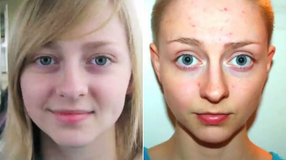 Woman With Hair Loss Condition Captures Transformation in Time Lapse Video  - ABC News
