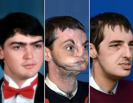 Face Transplant Patient Delights in Transformation - ABC News