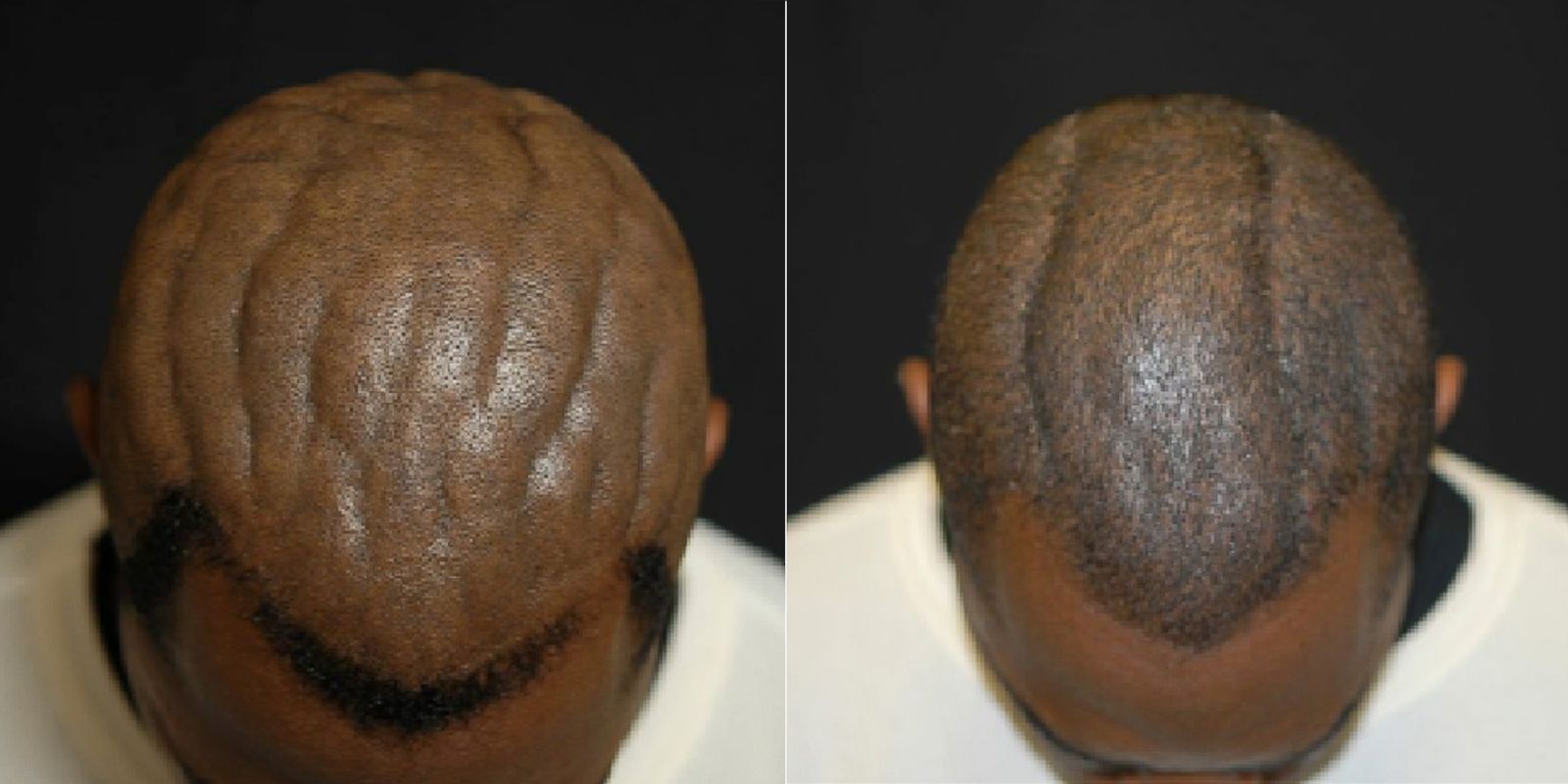 Scalp Surgery Corrects Cutis Verticis Gyrata Picture Medical Marvels 