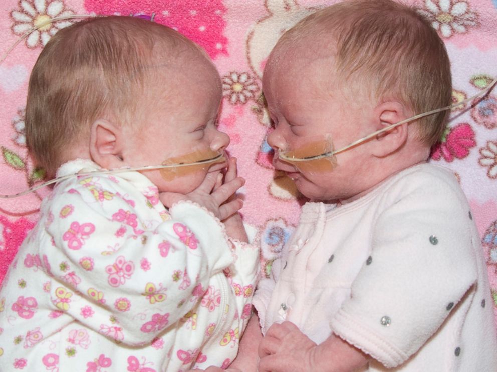PHOTO: Sophia and Delia born at Saint Luke's East Hospital in Lee's Summit, Missouri.